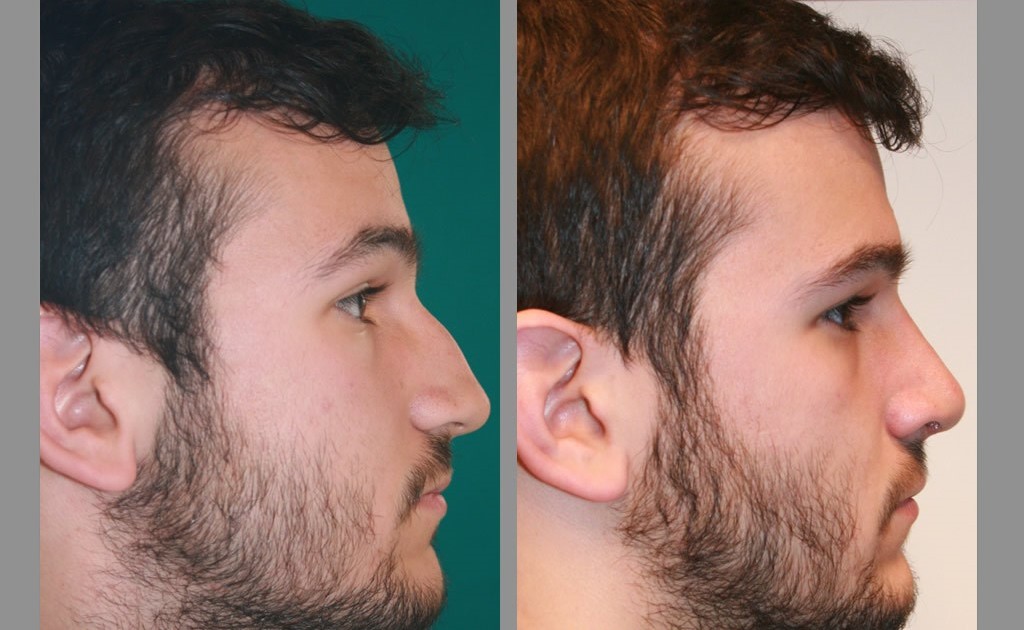 rinoplastia antes y despues nariz ancha